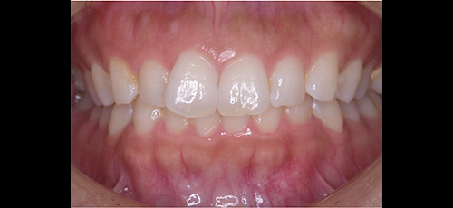 健康な歯ぐきの状態-1