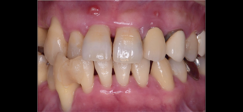 重度の歯周病-1